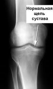 Нормальный коленный сустав